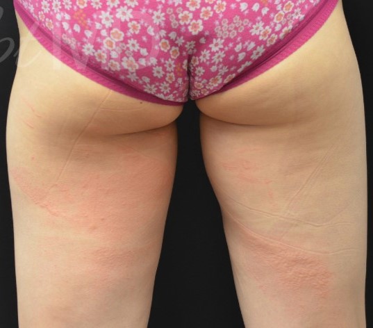 After Image: Inner-thighs - back