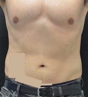 After Image: Abdomen - front