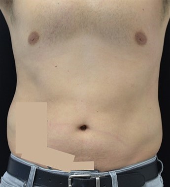 Before Image: Abdomen - front