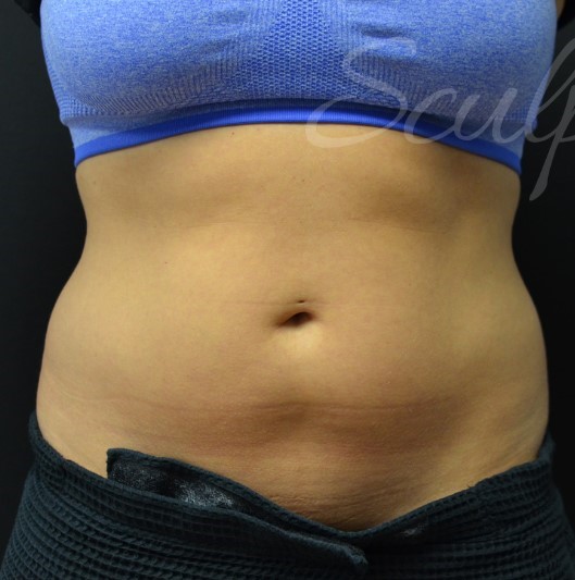 Before Image: Abdomen - front