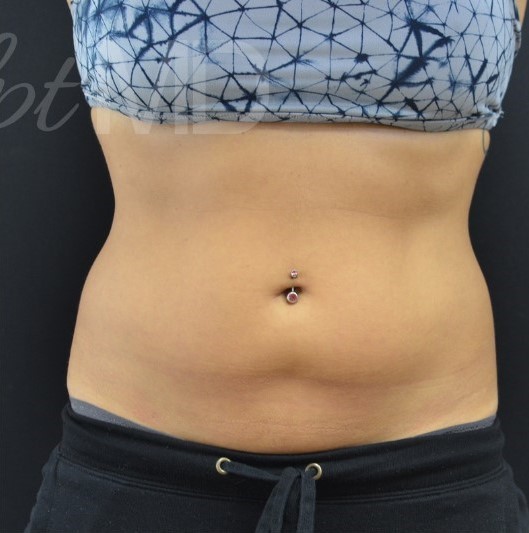 After Image: Abdomen - front