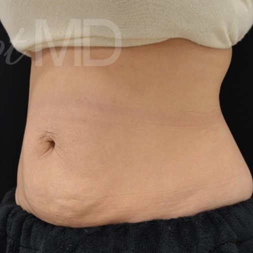After Image: Abdomen - left-front-oblique