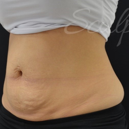 Before Image: Abdomen - left-front-oblique