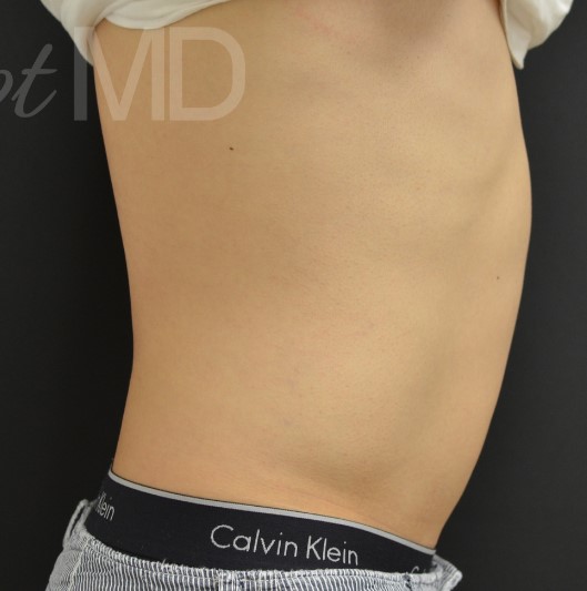 After Image: Abdomen - right-side