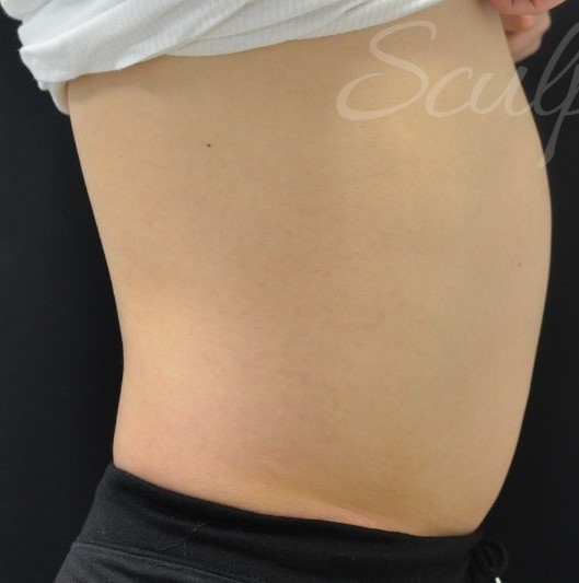 Before Image: Abdomen - right-side