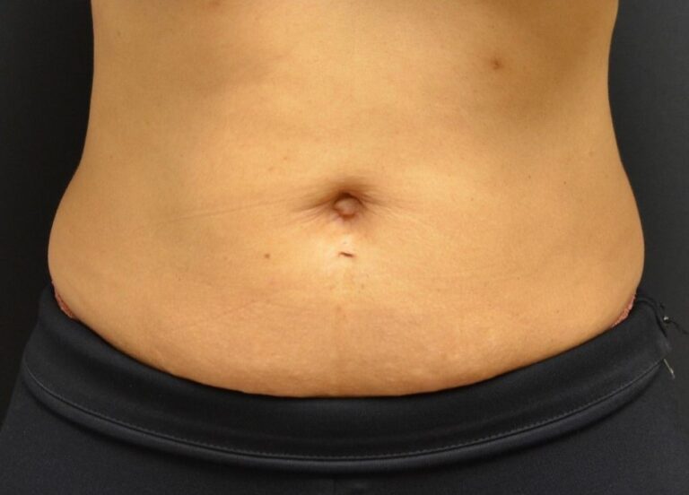 After Image: Abdomen - front