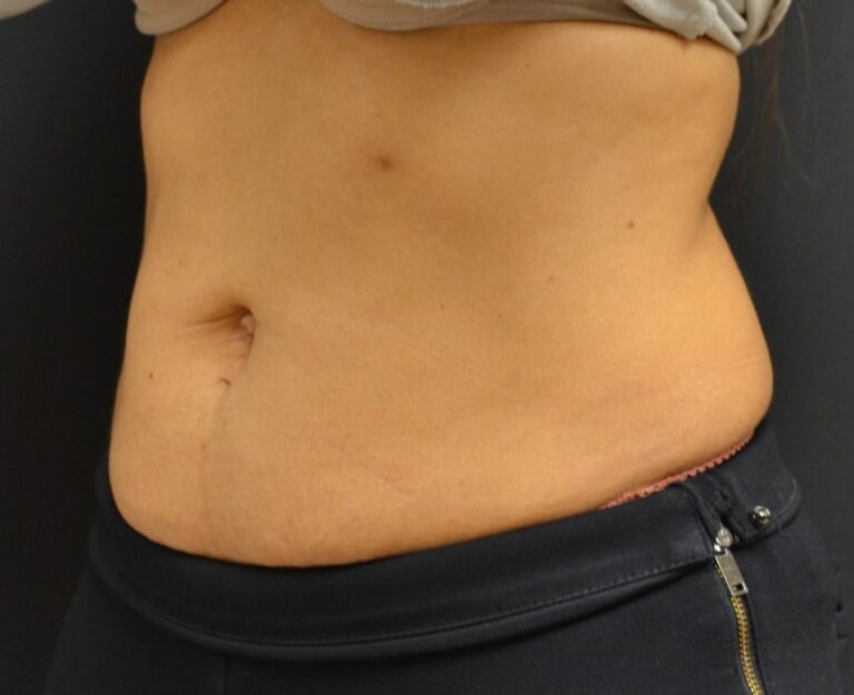 After Image: Abdomen - left-front-oblique