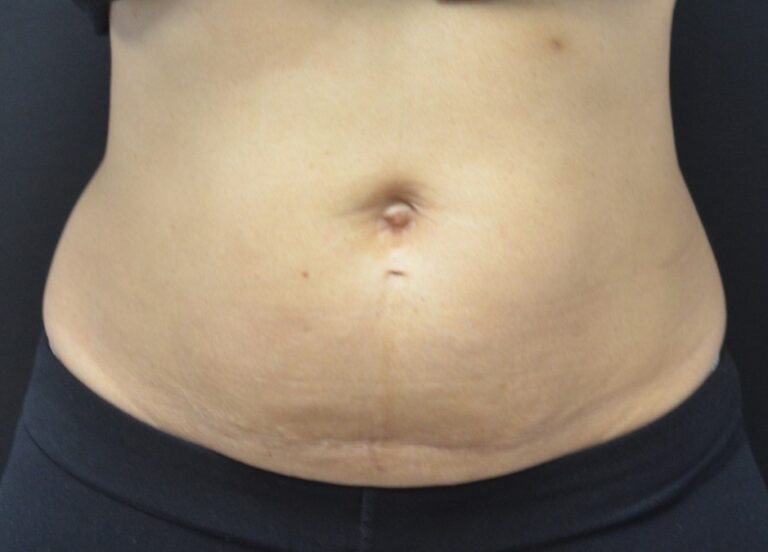 Before Image: Abdomen - front