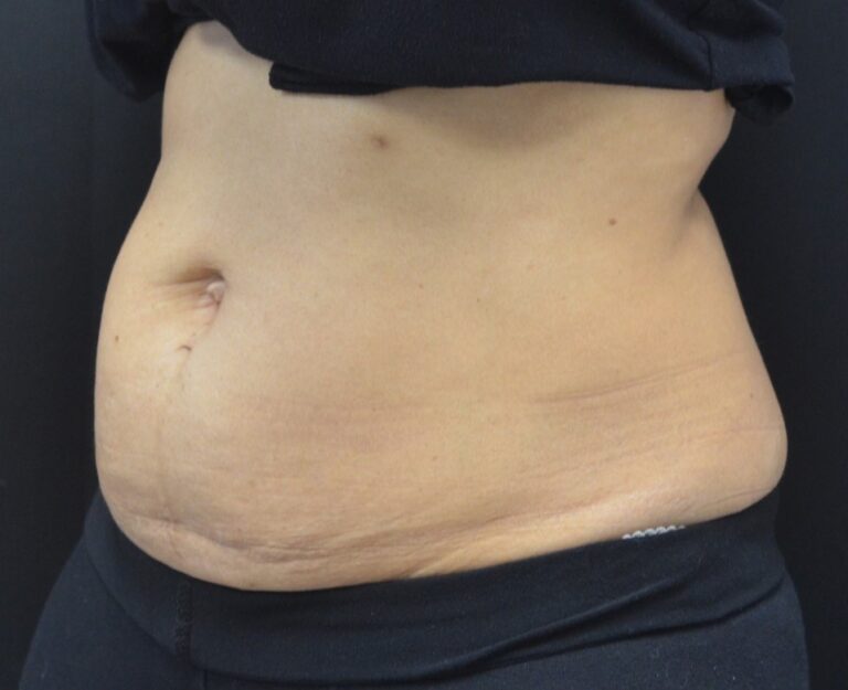 Before Image: Abdomen - left-front-oblique