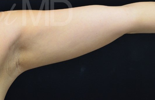 Before Image: Arms - front