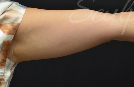 After Image: Arms - front