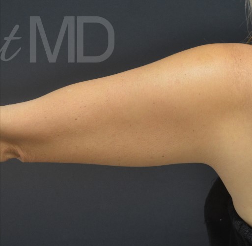 After Image: Arms - back