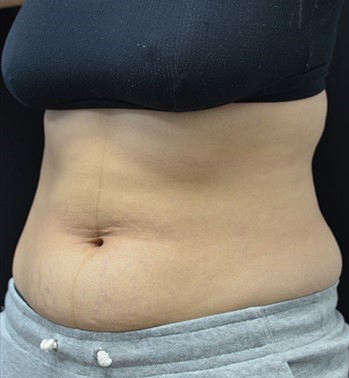 Before Image: Back - left-front-oblique