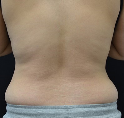 Before Image: Back - back