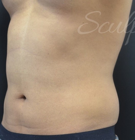 Before Image: Flanks - left-front-oblique