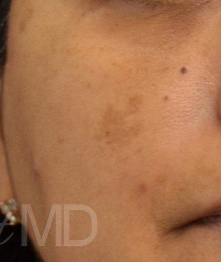 After Image: Esthetician Services - front