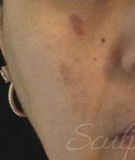 Before Image: Esthetician Services - front