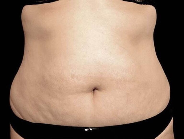 After Image: Abdomen - front