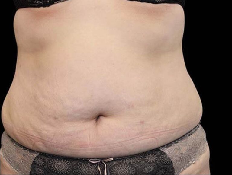 Before Image: Abdomen - front