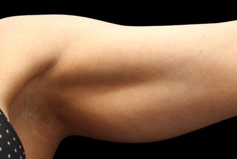 After Image: Arms - front