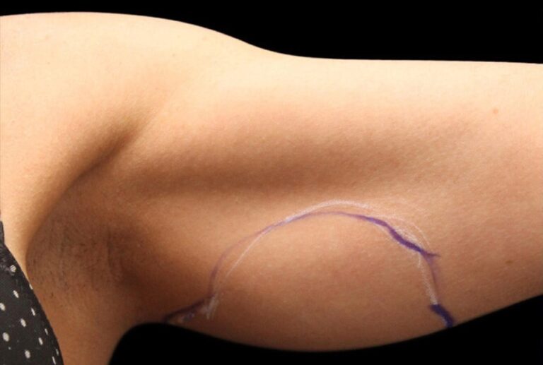 Before Image: Arms - front