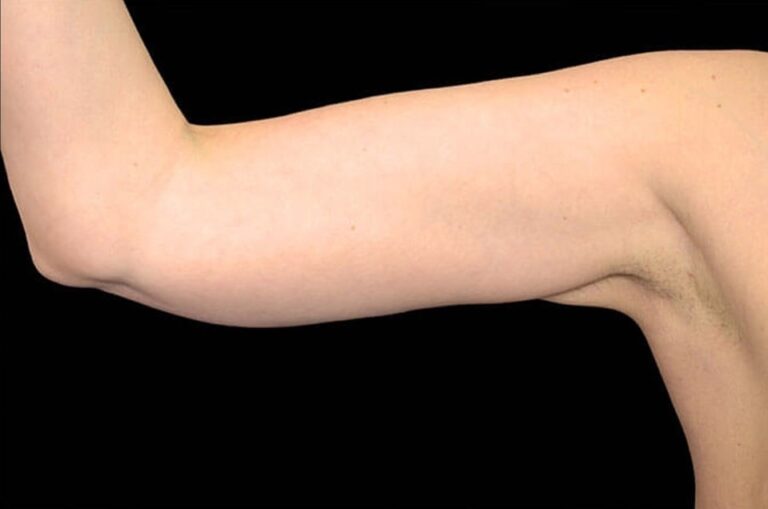 After Image: Arms - front