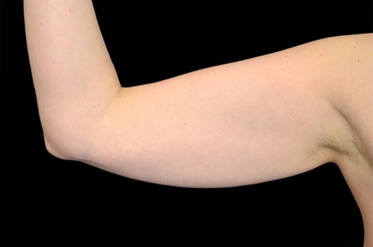 Before Image: Arms - front