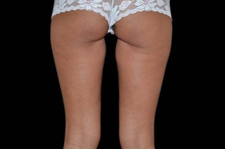 After Image: Buttocks - back