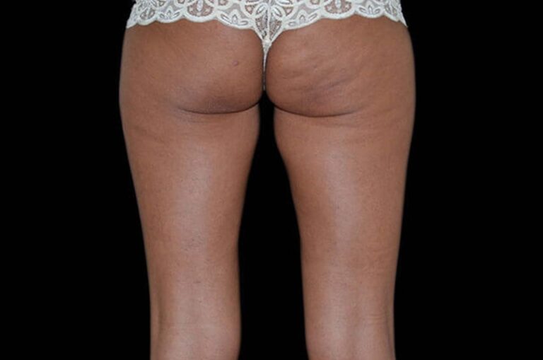 Before Image: Buttocks - back