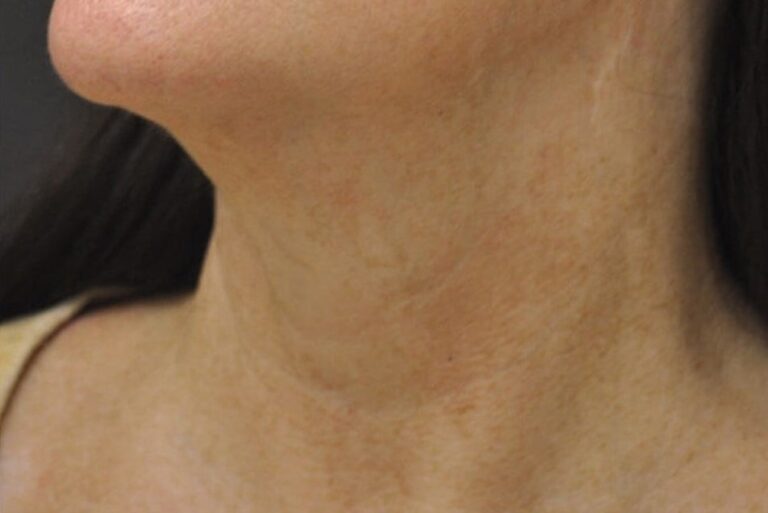 After Image: Chin - left-front-oblique