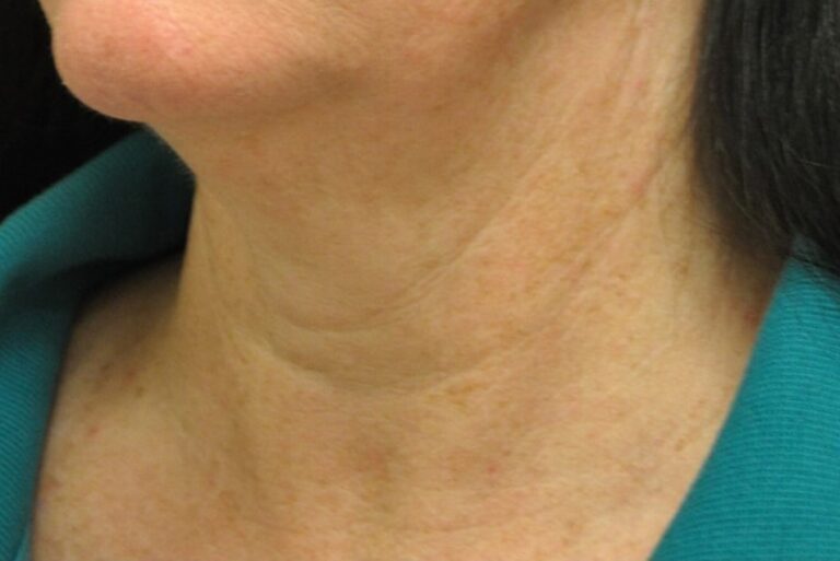Before Image: Chin - left-front-oblique
