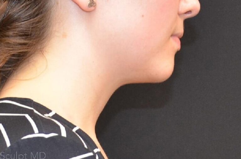 After Image: Chin - right-side