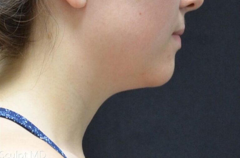 Before Image: Chin - right-side