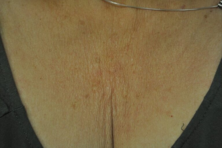 Before Image: Decollette - front