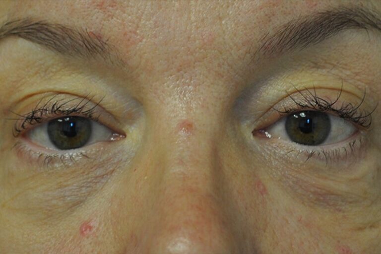 After Image: Eyes - front