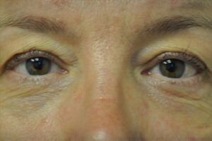 Before Image: Eyes