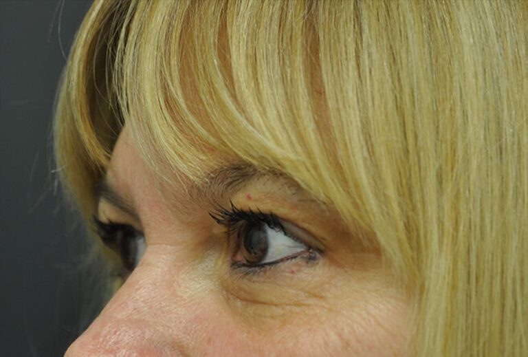 Before Image: Eyes - left-front-oblique