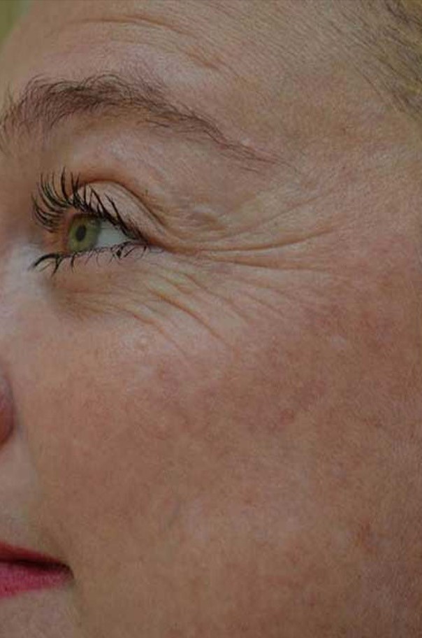 Before Image: Eyes - left-side