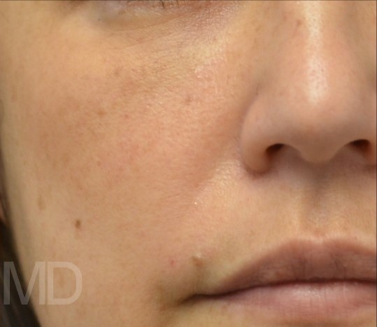 After Image: IPL Photofacial with BBL - front