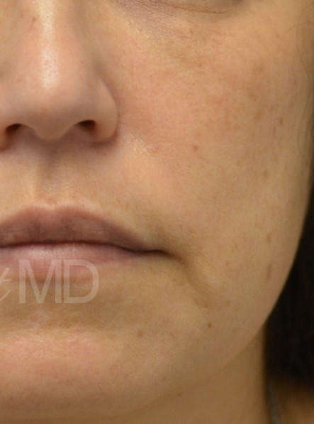 After Image: IPL Photofacial with BBL - front