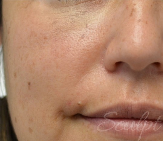 Before Image: IPL Photofacial with BBL - front