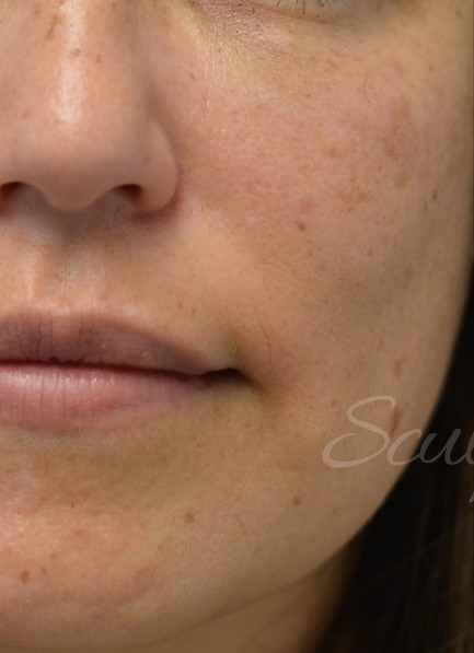 Before Image: IPL Photofacial with BBL - front