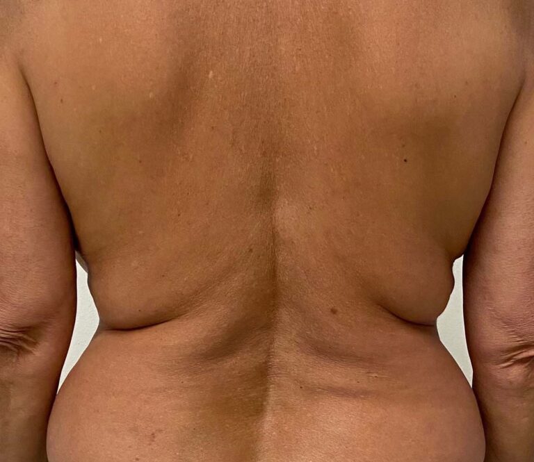 Before Image: Body - back