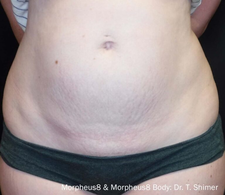 After Image: Body - front