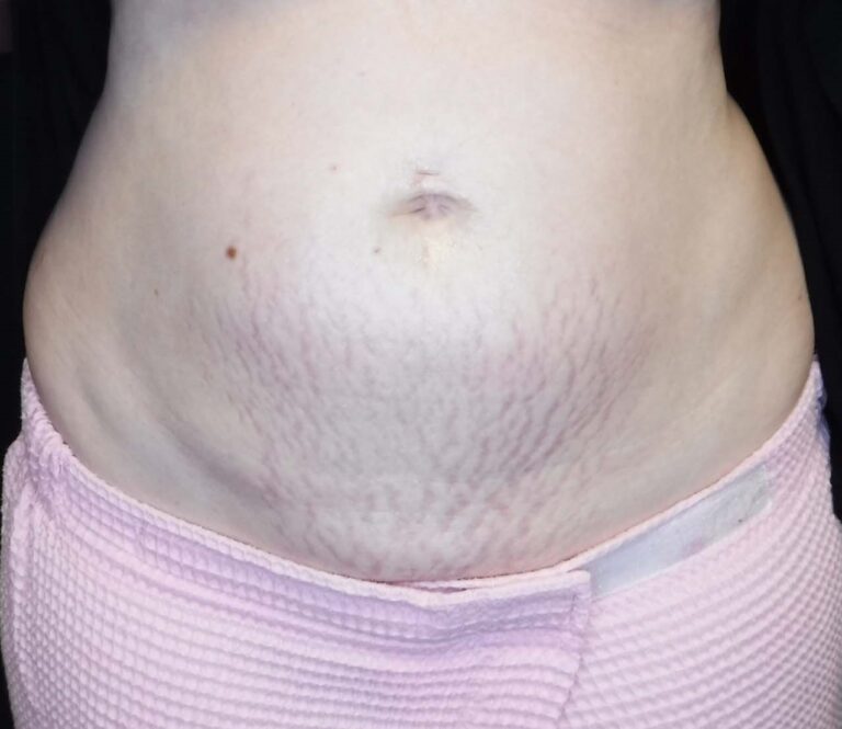 Before Image: Body - front