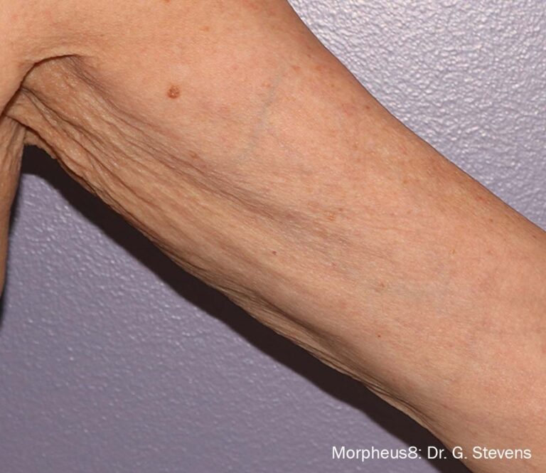 After Image: Body - front