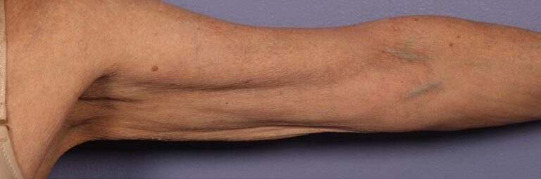 Before Image: Body - front