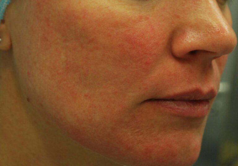 Before Image: Face - right-front-oblique