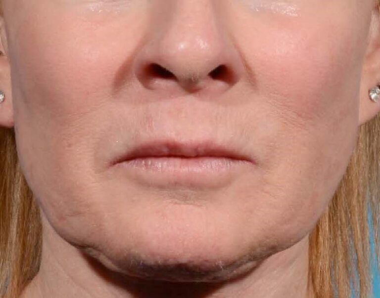Before Image: Face - front