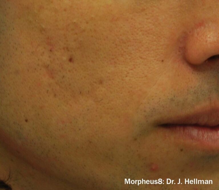 After Image: Face - right-front-oblique